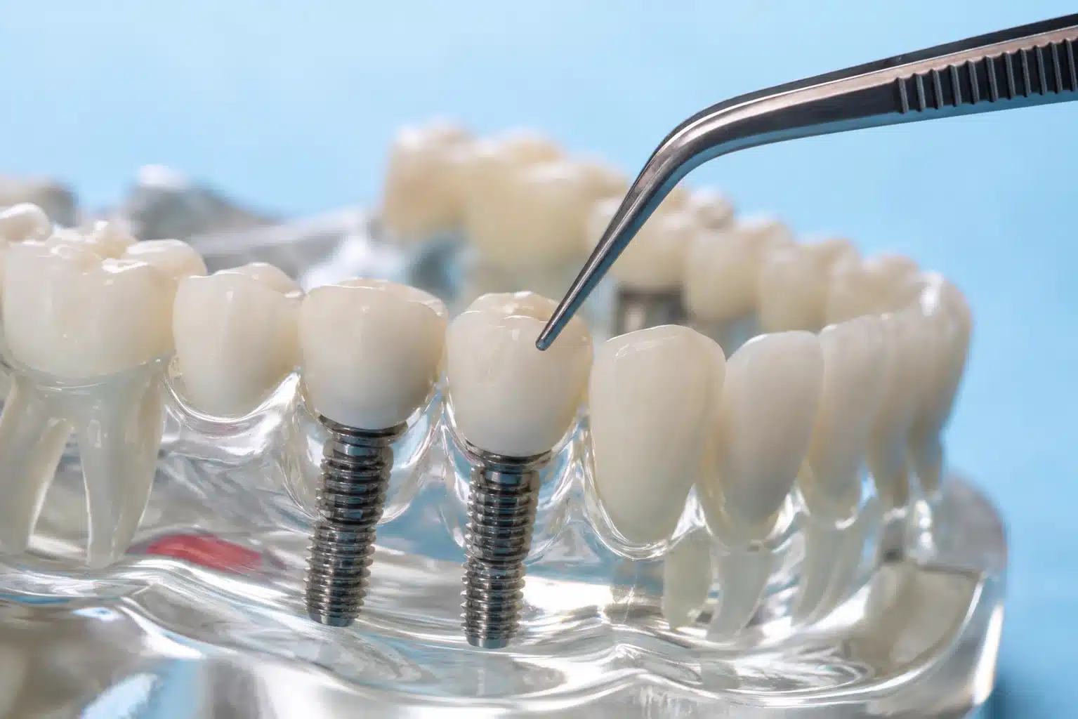 Dental implant treatment at the Krishna Nagar clinic