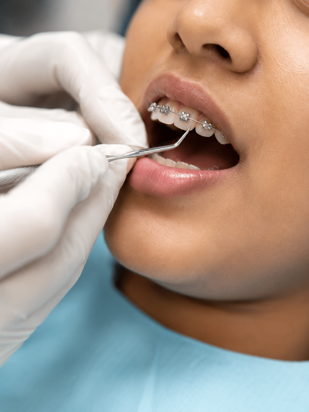 Orthodontic treatment at the Krishna Nagar clinic