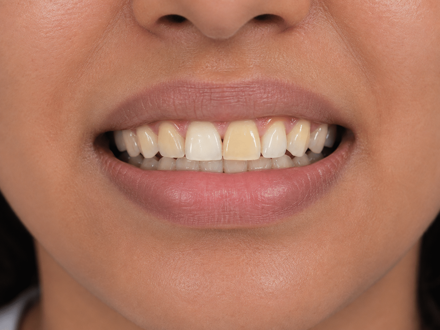 Smile makeover assessment and consultation