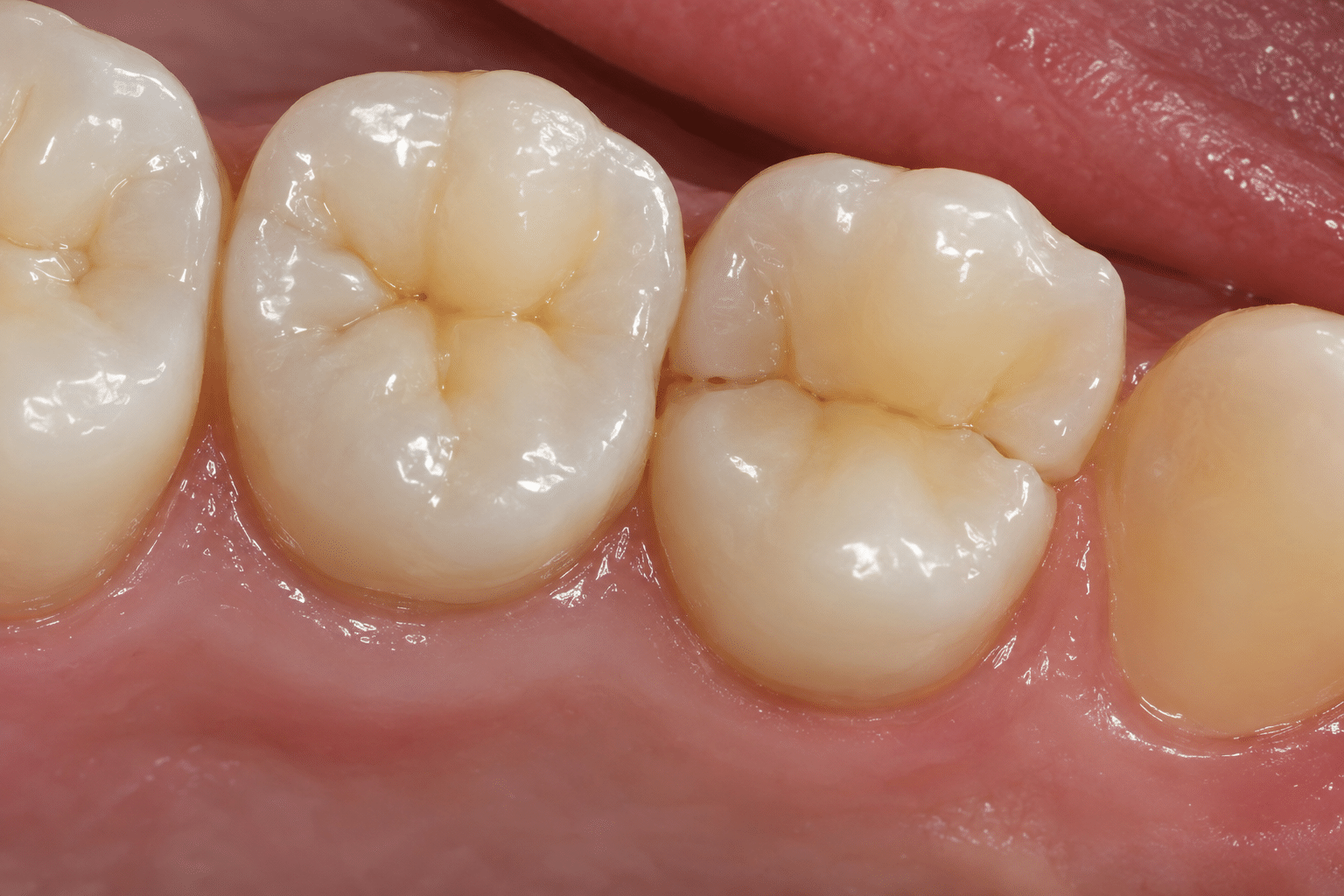 Signs of a fractured tooth