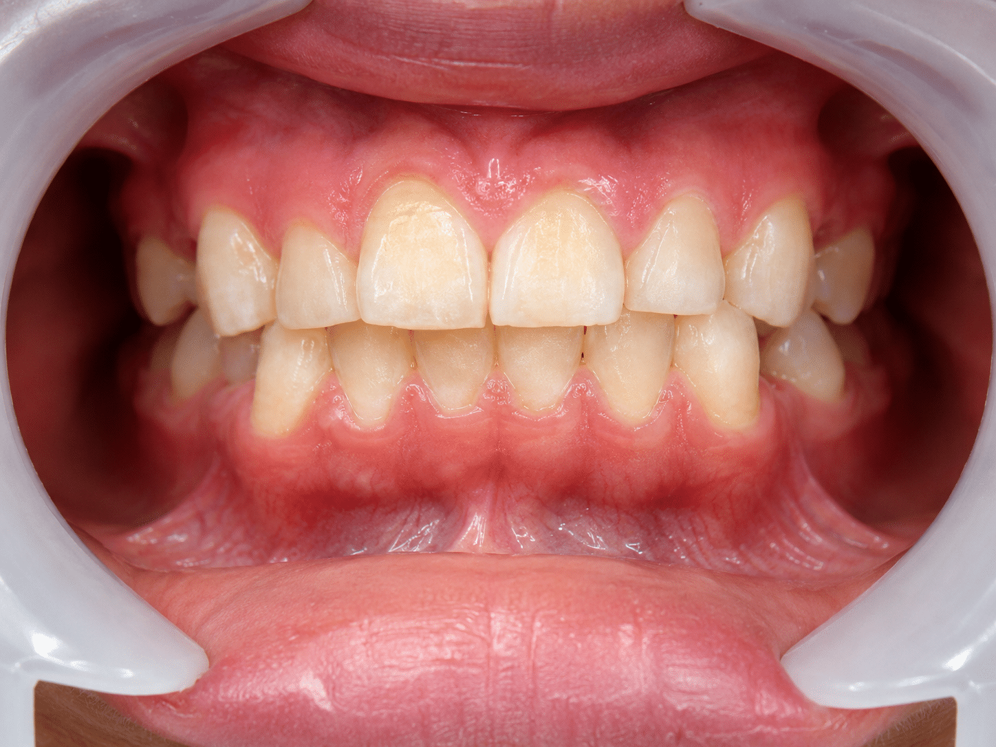 Teeth Whitening & Cleaning - Before